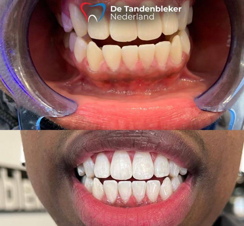 tanden-laten-bleken-leiden